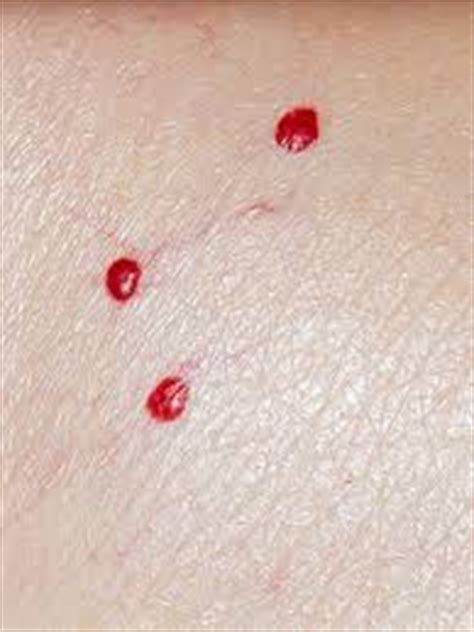 <b>Campbell</b> de <b>Morgan</b> <b>spots</b>, also known as cherry angiomas, are common, benign <b>skin</b> lesions of middle to older age, formed by proliferating, dilated capillaries and postcapillary venules. . Blood spots on skin nhs pictures